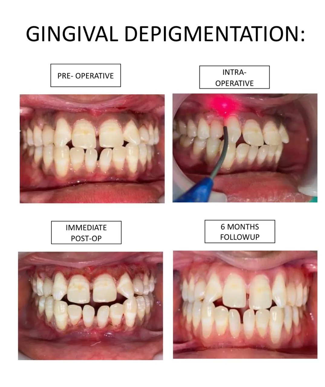 Gingival Depigmentation - Before
