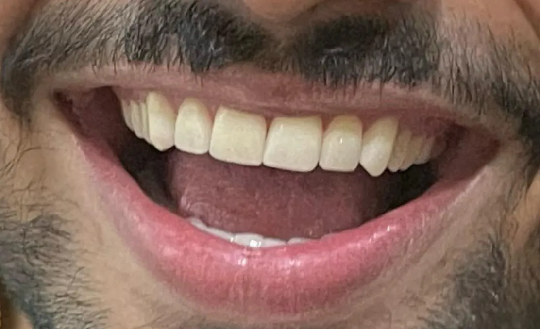 Smile Correction - After