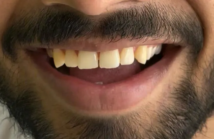 Smile Correction - Before