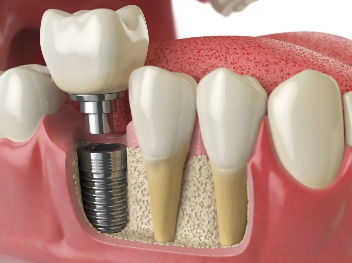 Dental implant model showing titanium post and ceramic crown