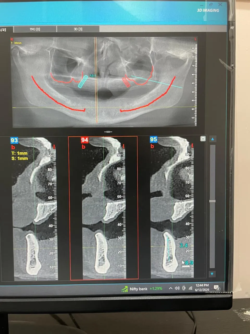 Digital Implant Planning