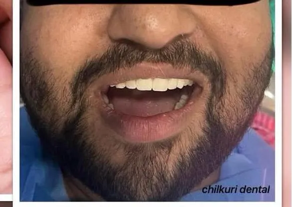 Single Tooth Replacement - After