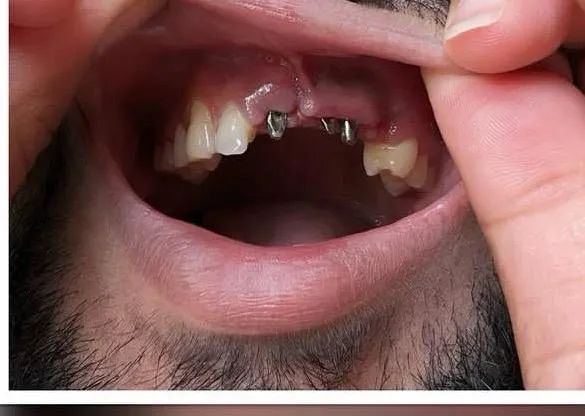 Single Tooth Replacement - Before